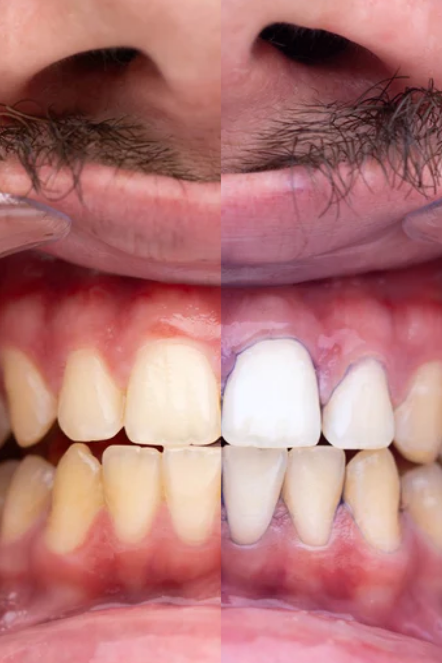Comparación visual real del tono dental antes y después