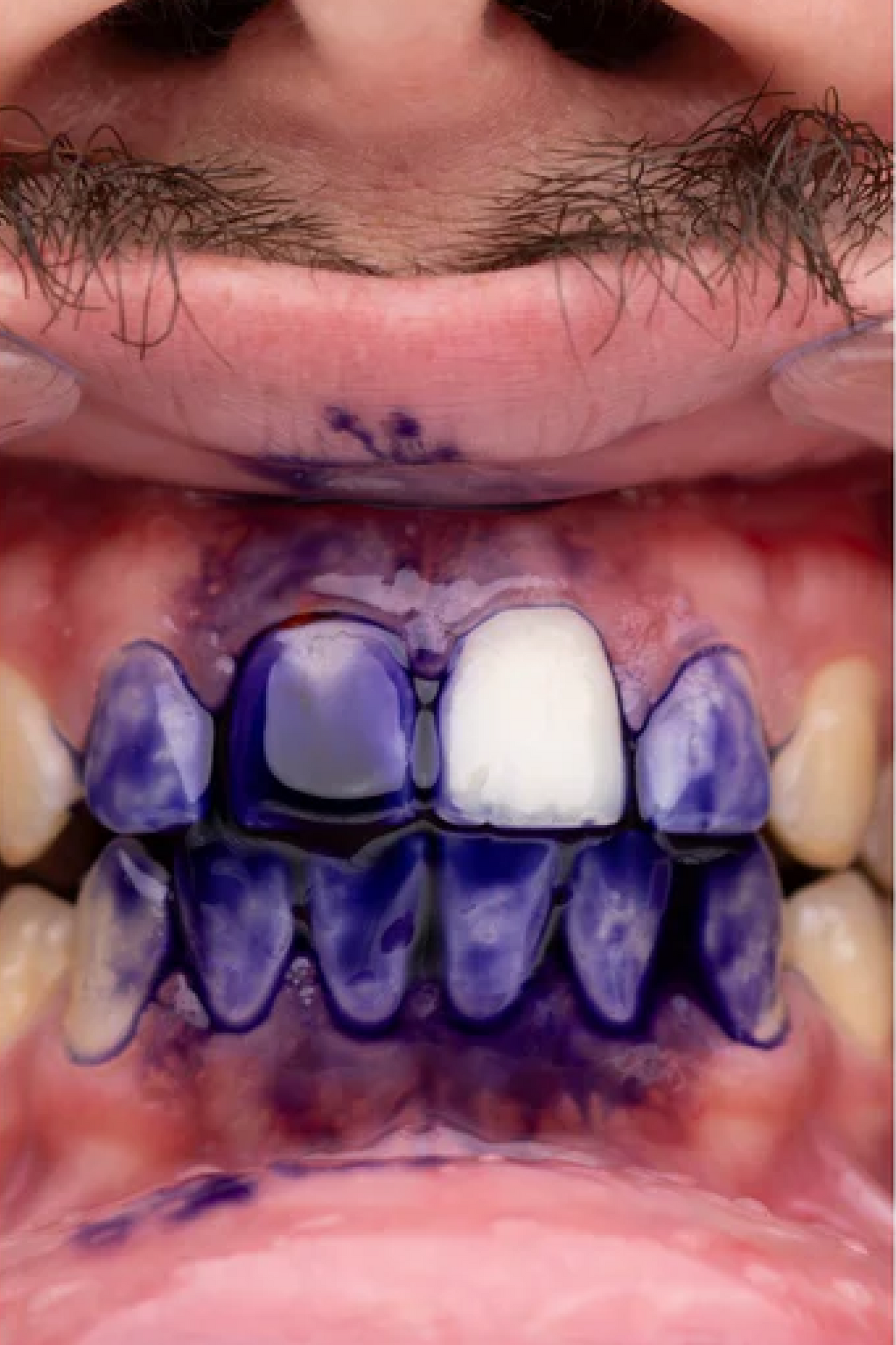 Aplicación real de Purple V34 sobre los dientes